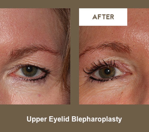 Klapper Eyelid & Facial - Indianapolis, IN