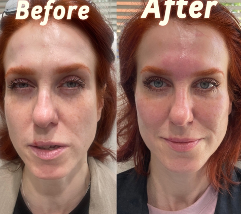 4ever Young STL - St.Louis, MO. Before and After Cheeks Fillers