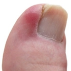 Ingrown Toenail Therapy