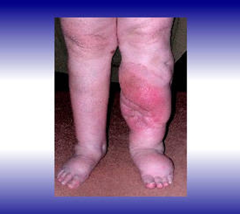 Lymphoedema Clinic Adelaide - Walkerville, SA