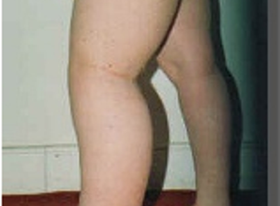 Lymphoedema Clinic Adelaide - Walkerville, SA