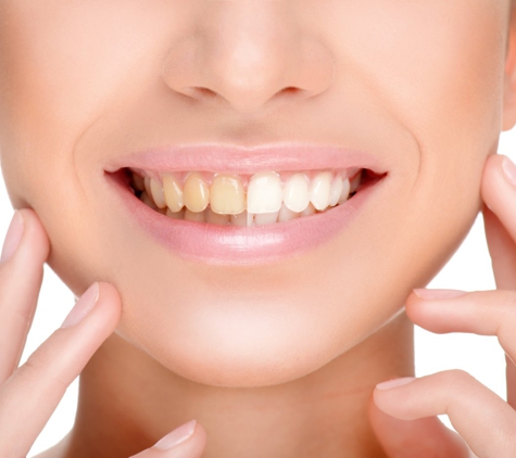 SINAI DENTAL - Van Nuys, CA. Teeth Whitening - Before and After