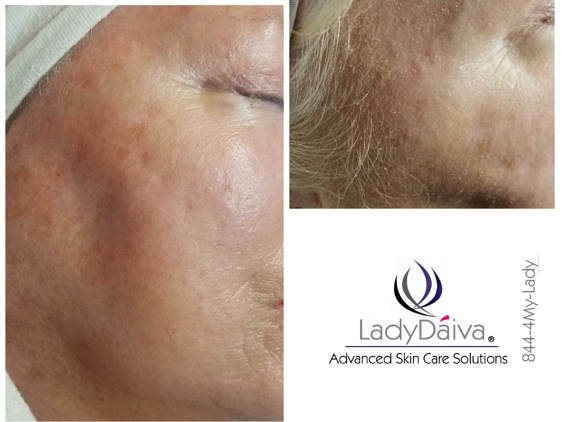 Lady Daiva Skin Care - Fort Myers, FL. Dermaplaning