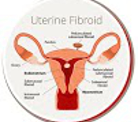 USA Fibroid Centers - Tomball, TX
