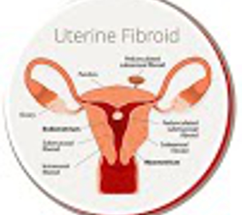 USA Fibroid Centers - Bronx, NY