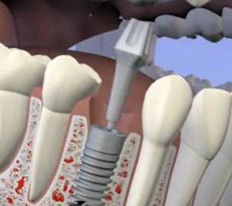 Alipaz Family Dentistry - San Juan Capistrano, CA. Dental Implants