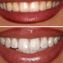 Brighter Smiles Advanced Teeth Whitening - Dental Clinics