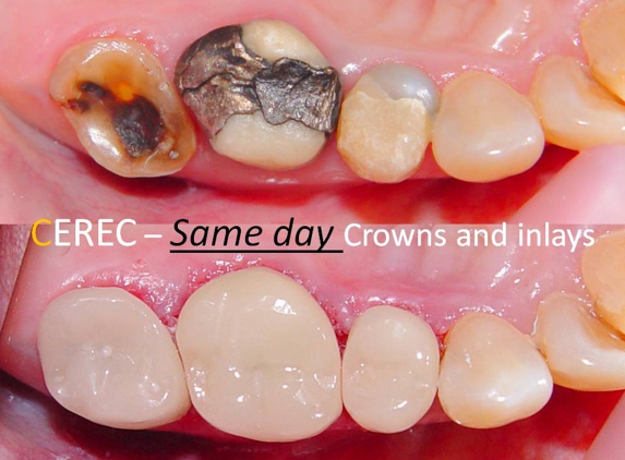 Sundial Dental Taree - Taree, NSW. Same day crowns