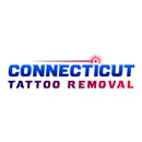 Connecticut Tattoo Removal - Tattoo Removal