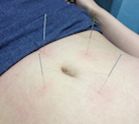 Accurate Acupuncture by Remington Zhang - Hilliard, OH