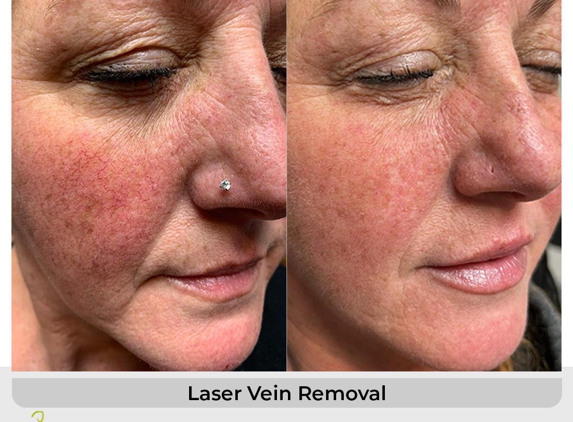 BODi Louisville (formerly BodyRX Louisville) - Louisville, KY. Laser vein treatment Louisville