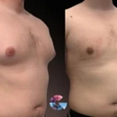 Gynecomastia Surgery Center in Los Angeles - Medical Clinics