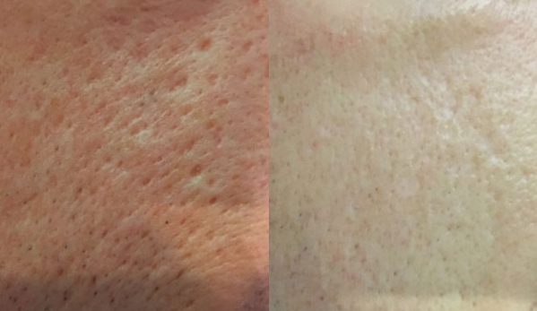 Edward Stolar MD - Washington, DC. Acne Treatment in Washington, DC 20006 x