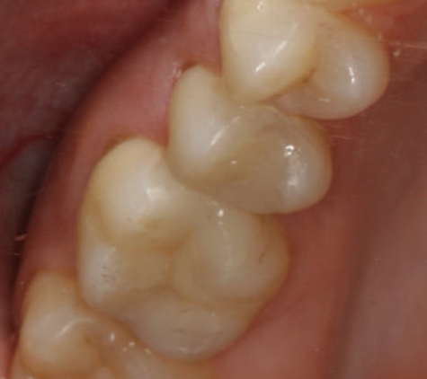 Brice Dental Surgery - Ayr, QLD. PORCELAIN CROWNS