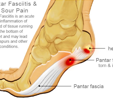All Podiatry Services - Parkside, SA. Heel Pain