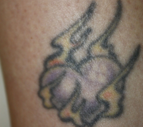 Vanish Laser Tattoo Removal and Skin Aesthetics - Fort Worth, TX