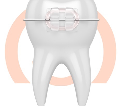 Schroeder Orthodontics - Southlake, TX. Ceramic braces are made of clear materials and are therefore less visible on your teeth than metal braces.