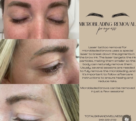 Total Skin and Wellness - San Clemente, CA. Say goodbye to eyebrow tattoos!