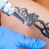 Lexington Tattoo Removal gallery
