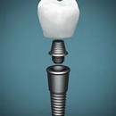 Lumon Dental - Implant Dentistry