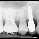 Better Living Through Dentistry™ - Implant Dentistry