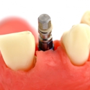 SEDA Dental of Jupiter - Implant Dentistry