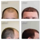 Natural Transplant, Hair Restoration Clinic - Hair Replacement
