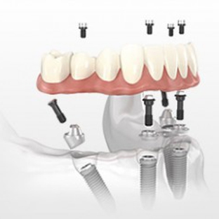 Miracle Smile Dentistry - Coral Gables, FL. Fixed Implants Denture - All on 4