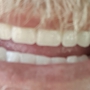 Affordable Dentures & Implants