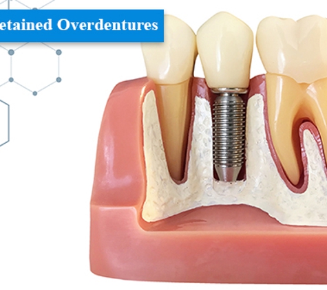 Natural Denture Clinic (Port Noarlunga) - Port Noarlunga, SA. Implant Retained Overdentures