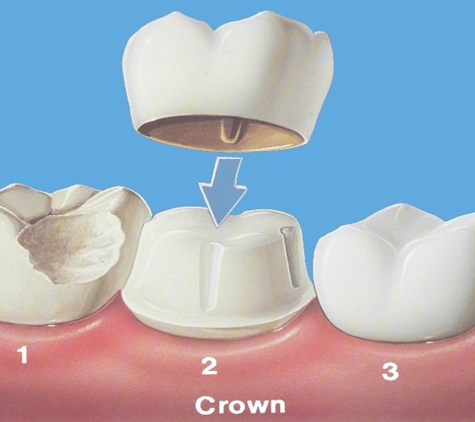 O'Halloran Hill Dental - O'halloran Hill, SA. Dental Capping
