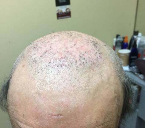 Thinning Hair Solutions - Stamford, CT