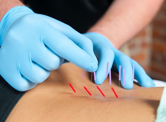 Acupuncture Center of Rapid City - Rapid City, SD. Acupuncture and Dry Needling are only to be performed by a qualified acupuncturist in SD