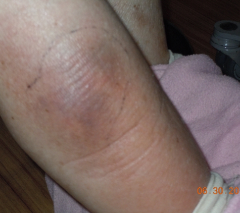 V M P-Manor Park - Milwaukee, WI. Leg hematoma not documented, but ER has record.