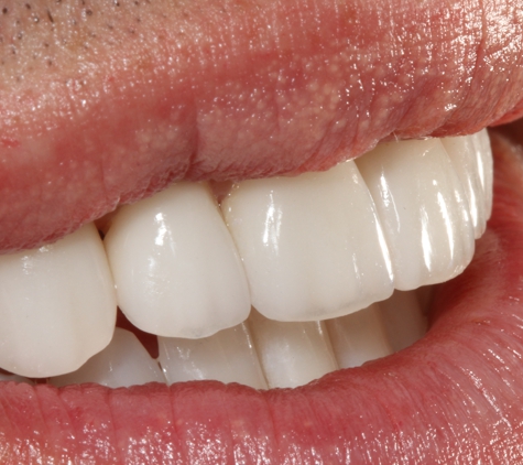 Infusion Dental Arts - El Dorado Hills, CA. E.max veneers