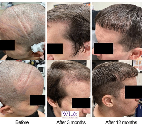 West LA Hair Restoration - Los Angeles, CA