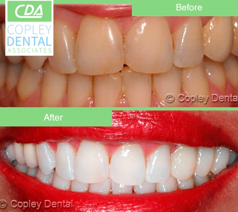Copley Dental Associates - Boston, MA. #teeth whitening
#cosmeticdentist