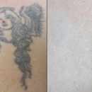 Vanish Laser Tattoo Removal and Skin Aesthetics - Skin Care