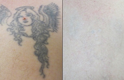 100+ [ Laser Tattoo Removal Oklahoma Skin ] | Oklahoma ...