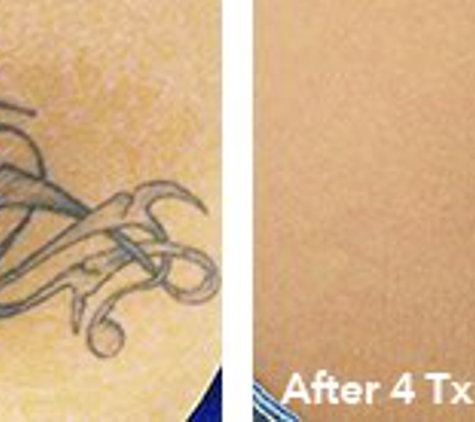 Eraser Clinic Laser Tattoo Removal - Austin, TX