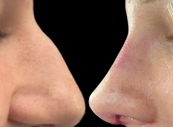 Okland Facial Plastic Surgery - Denver, CO. Rhinoplasty, Nose Job