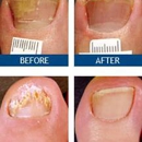 Laser Nail Therapy - Largest Toenail Fungus Treatment Center - Physicians & Surgeons, Podiatrists