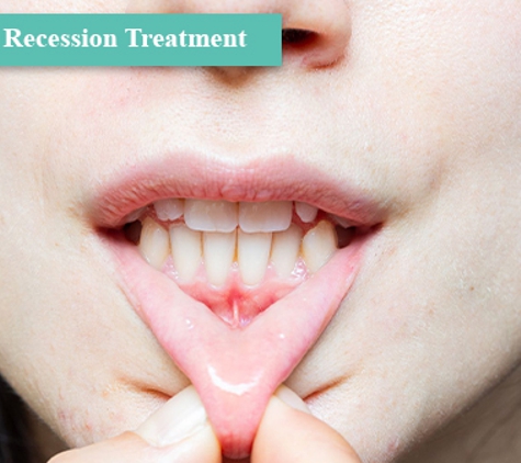 Perio Health Specialists - Dandenong, VIC. Gingival Recession Treatment