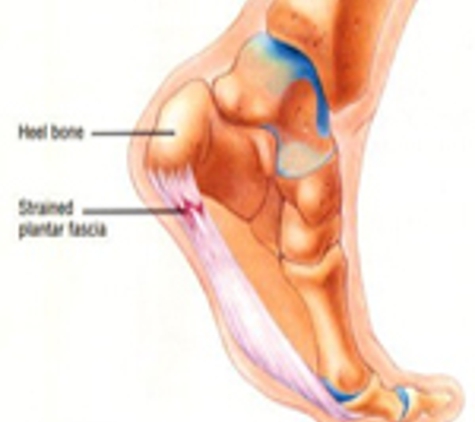 Darwin Podiatry - Darwin City, NT. Heel Pain