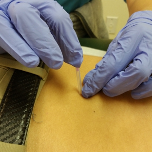 Premier Physical Therapy - Arlington, TX. Dry Needling