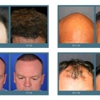 Complete Hair Restoration gallery