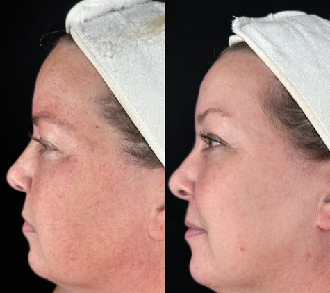 Crystal Skin Care - Kaysville, UT. IPL: Before and After