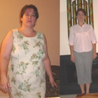 Gastric Sleeve Mexico