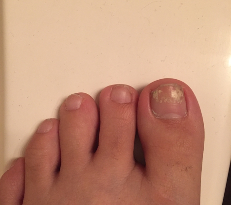 A Plus Nails - Henderson, NV. L foot nail fungus