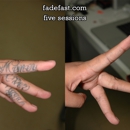 Fade Fast Laser Tattoo Removal - Tattoo Removal